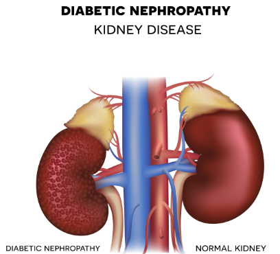 Diabetes and kidney disease